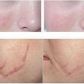 Laser CO2 fractional MD02