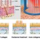 Laser CO2 Fractional MD03